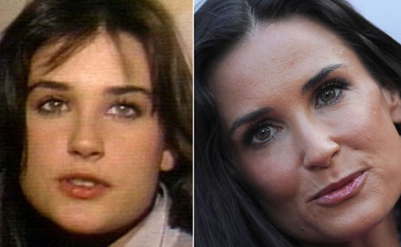 Demi Moore before and after plastic surgery