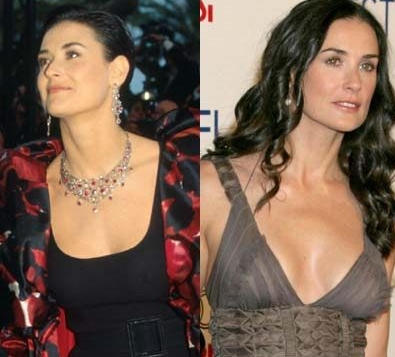 Demi Moore plastic surgery