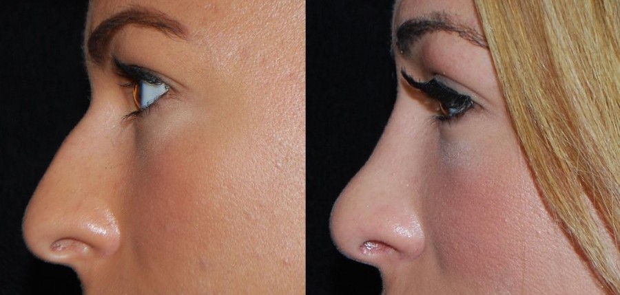 Rhinoplasty (nose job) - before and after cosmetic procedure