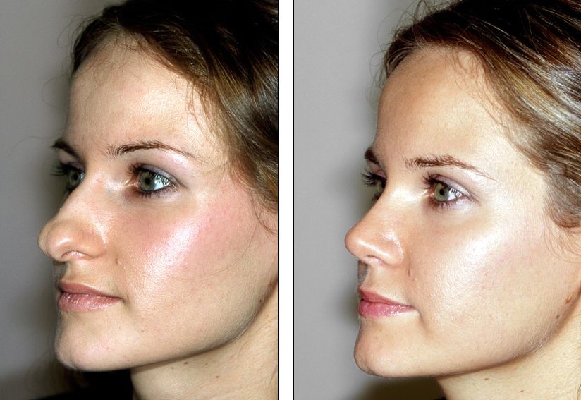 Rhinoplasty (nose job) - before and after cosmetic procedure