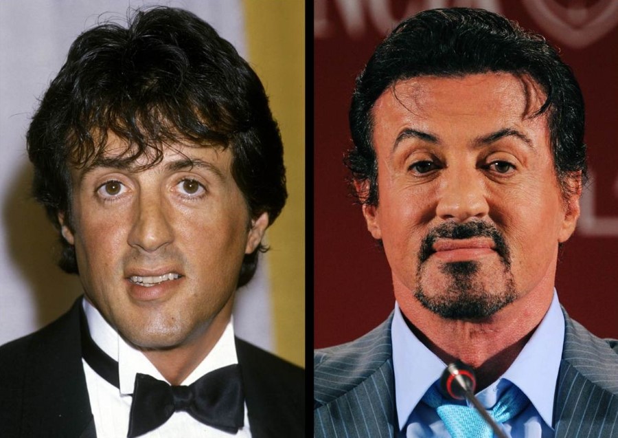 Sylvester Stallone Plastic Surgery corrected sagging face.