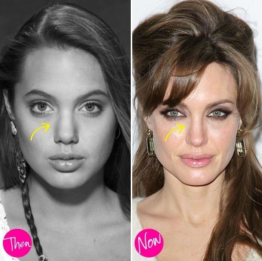 Angelina Jolie plastic surgery tweaks to improve her beauty!