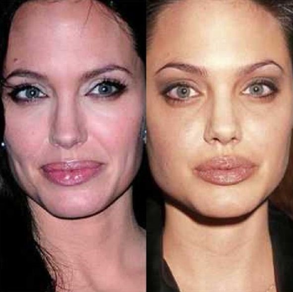 Angelina Jolie before and after plastic surgery 08