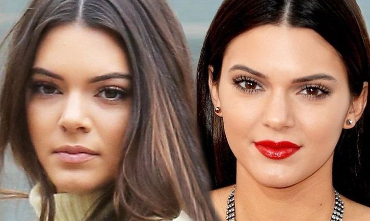 Kendall Jenner also uses Plastic Surgery like her sisters?