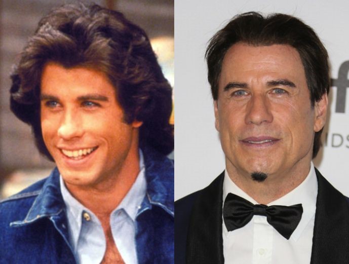 John Travolta plastic surgery Botox and hair transplant?
