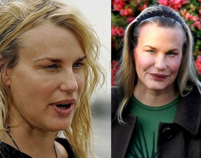Daryl Hannah before and after plastic surgery