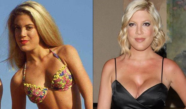 Tori Spelling before and after plastic surgery