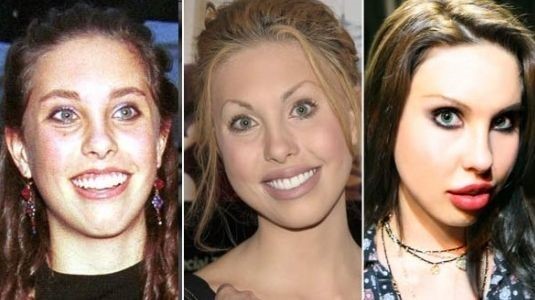 Chloe Lattanzi before and after plastic surgery 41 – Celebrity plastic