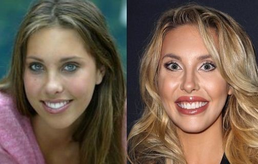 Chloe Lattanzi before and after plastic surgery