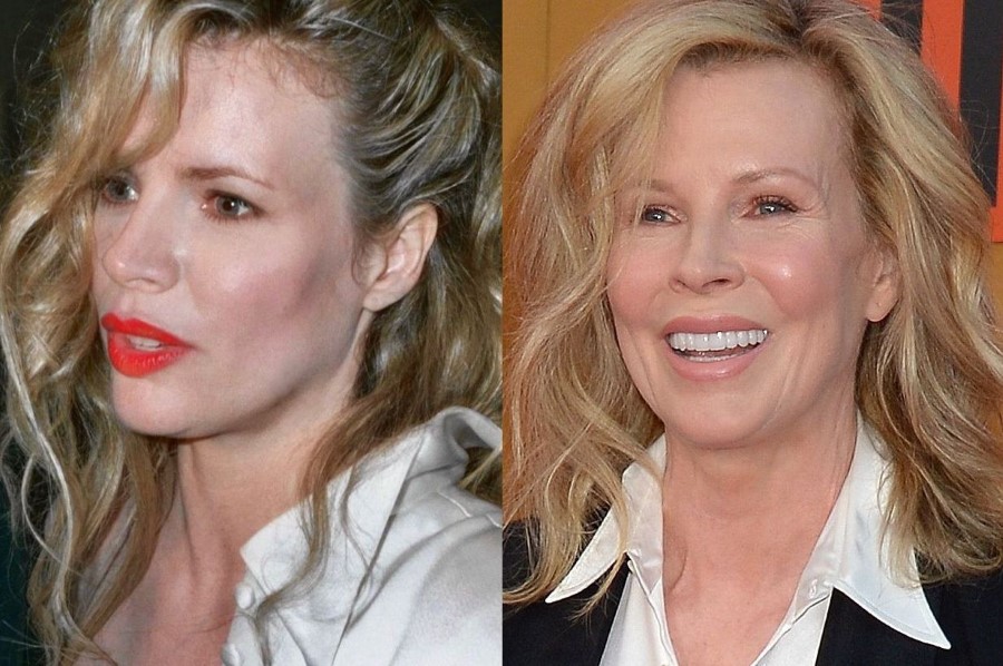 Kim Basinger before and after plastic surgery 39