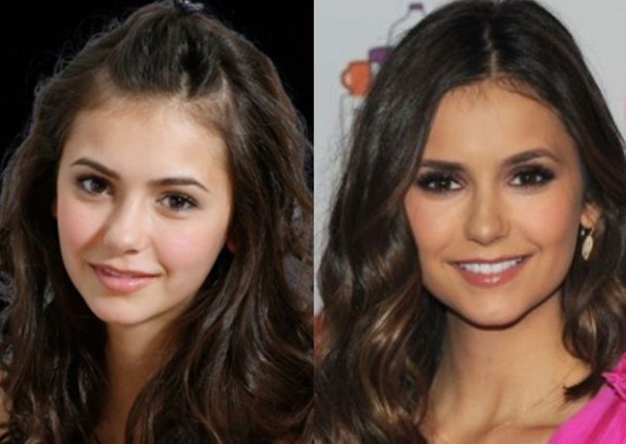 Nina Dobrev before and after plastic surgery (21