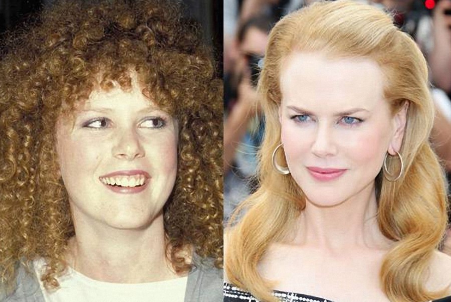 Nicole Kidman and her plastic surgery procedures