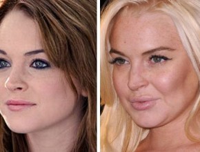Lindsey Lohan before and after plastic surgery