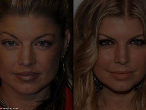 Fergie  before and after plastic surgery 81