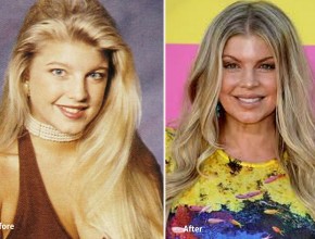 Fergie  before and after plastic surgery 91