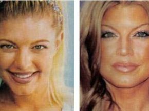 Fergie plastic surgery - Nose job