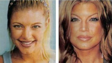 Fergie plastic surgery - Nose job