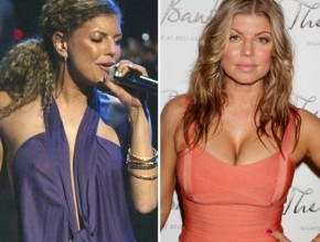 Fergie before and after breast implants