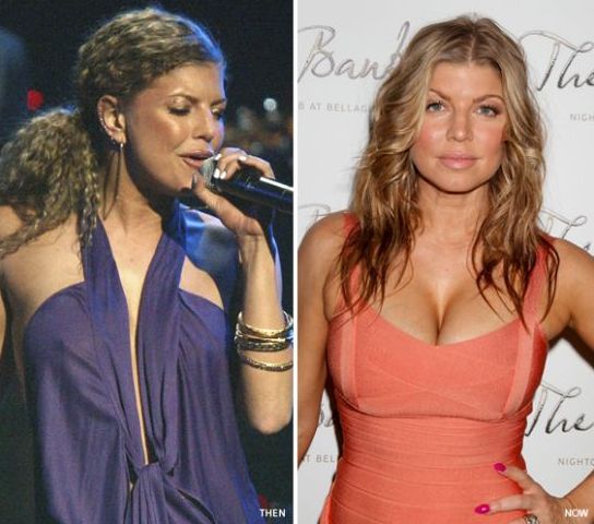 Fergie before and after breast implants