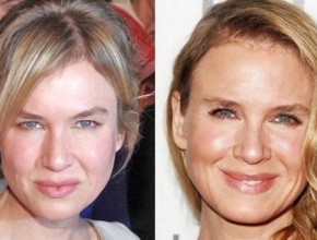 Rene Zellweger before and after plastic surgery