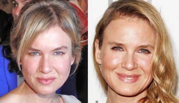 Rene Zellweger before and after plastic surgery