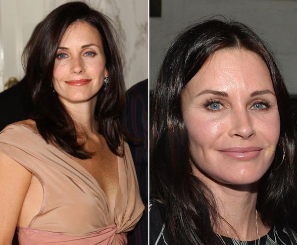 Courteney Cox before and after plastic surgery