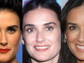 Demi Moore before and after plastic surgery