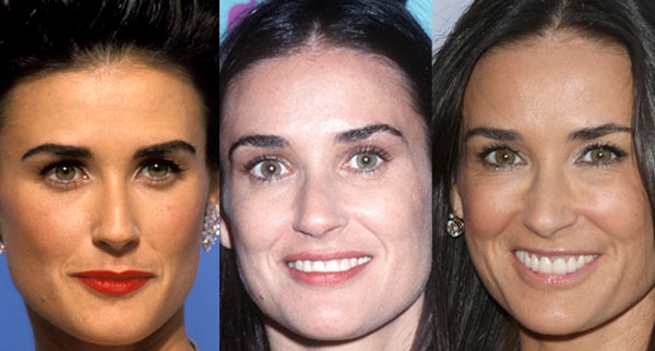 Demi Moore before and after plastic surgery