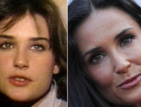 Demi Moore before and after plastic surgery