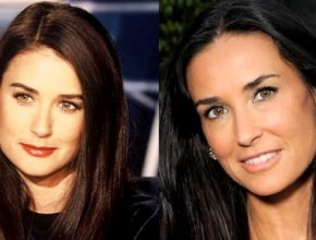 Demi Moore before and after plastic surgery