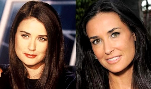 Demi Moore before and after plastic surgery