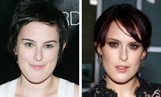 Rumer Willis plastic surgery