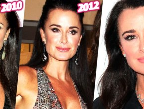 Kyle Richards before and after plastic surgery
