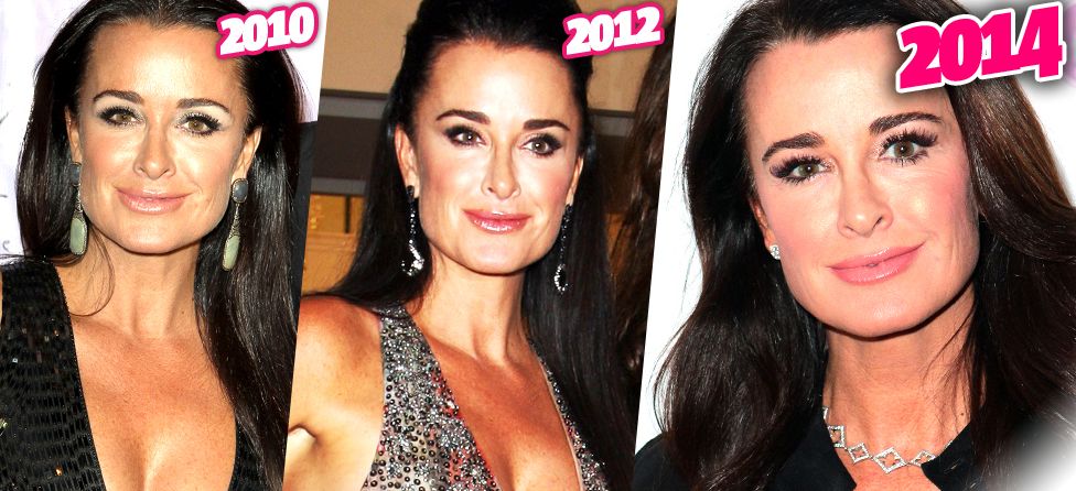 Kyle Richards before and after plastic surgery