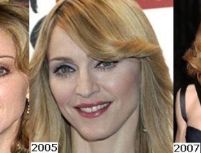 Madonna before and after plastic surgery