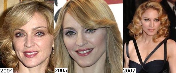 Madonna before and after plastic surgery