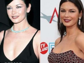 Catherine Zeta Jones before and after plastic surgery