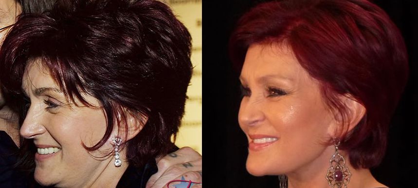 Sharon Osbourne  before and after plastic surgery