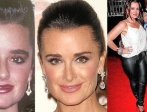 Kyle Richards before and after plastic surgery 2