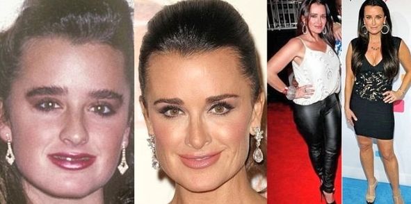 Kyle Richards before and after plastic surgery 2