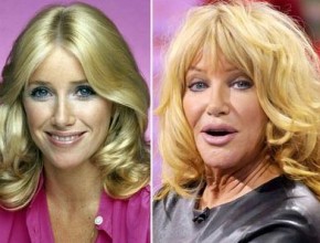 Suzanne Somers before and after plastic surgery