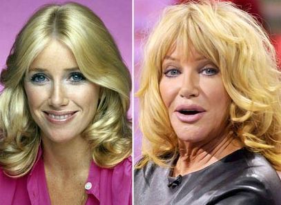 Suzanne Somers before and after plastic surgery