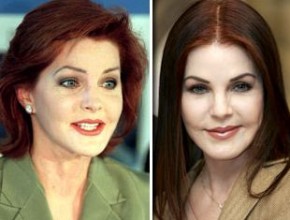 Priscilla Presley before and after plastic surgery