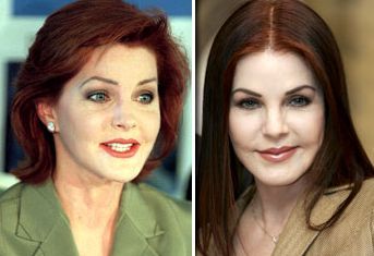 Priscilla Presley before and after plastic surgery