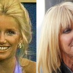 Suzanne Somers before and after plastic surgery 26