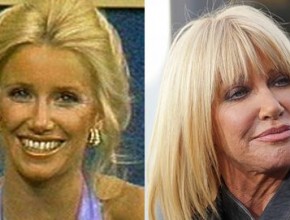 Suzanne Somers before and after plastic surgery 26