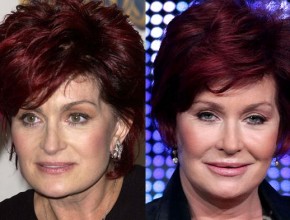 Sharon Osbourne  before and after plastic surgery