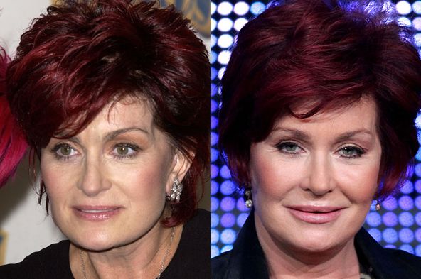 Sharon Osbourne  before and after plastic surgery