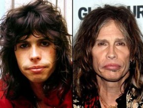 Steven Tyler before and after plastic surgery
