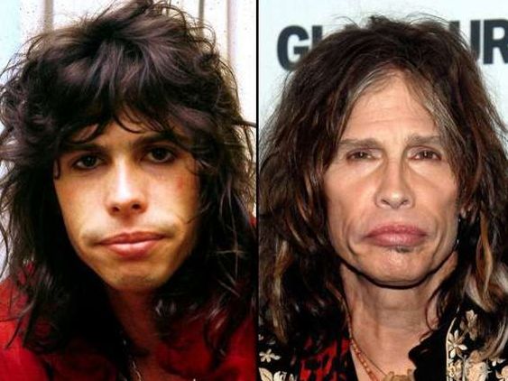 Steven Tyler before and after plastic surgery